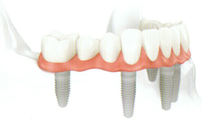 teeth implants dentist Florissant MO and Chesterfield MO