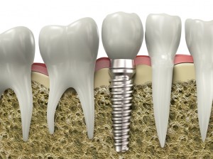 dental implant