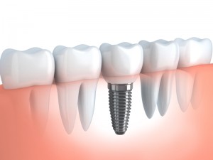 mini dental implants dentist Chesterfield MO and St Louis