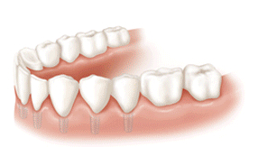 dental implants dentist in Chesterfield MO and St Louis