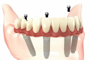 implant dentures dentist St Louis and Florissant