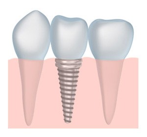 dental implants in Chesterfield MO