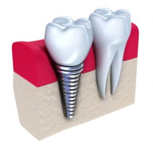 dental implants in Chesterfield MO