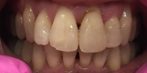 straight teeth in Chesterfield MO case
