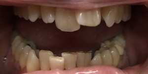 six month smiles clear braces in Chesterfield MO testimonial