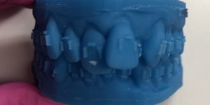 Chesterfield MO six month smiles testimonial