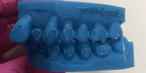 clear braces in six months Chesterfield MO