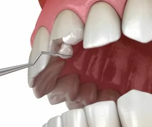 Composite Fillings - Chipped Tooth Repair - Town and Country Cosmetic Dentistry and Implants